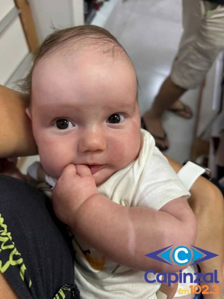 Cirurgia de bebê com fechamento precoce da moleira é adiada