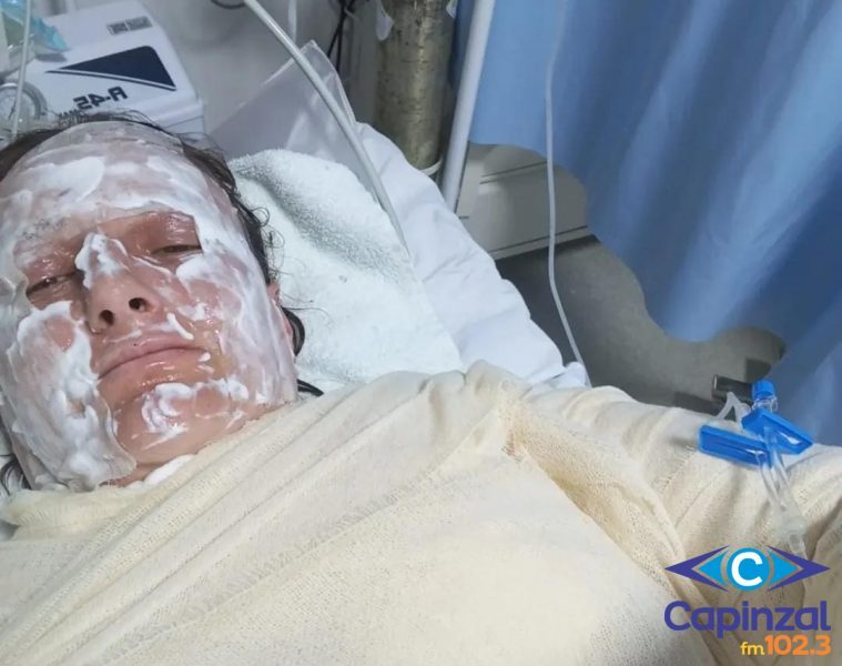 Moradora de Capinzal sofre queimaduras após explosão de frasco de aerossol dentro de churrasqueira
