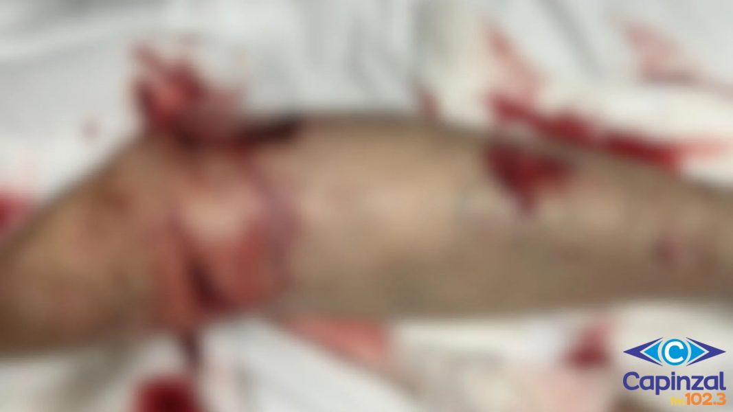 Funcionário terceirizado da Celesc é atacado por cachorro e fica gravemente ferido em SC